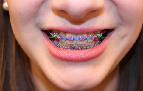 Biaya Pasang Behel di Ahli Gigi Murah Mulai dari 200 Ribu Saja